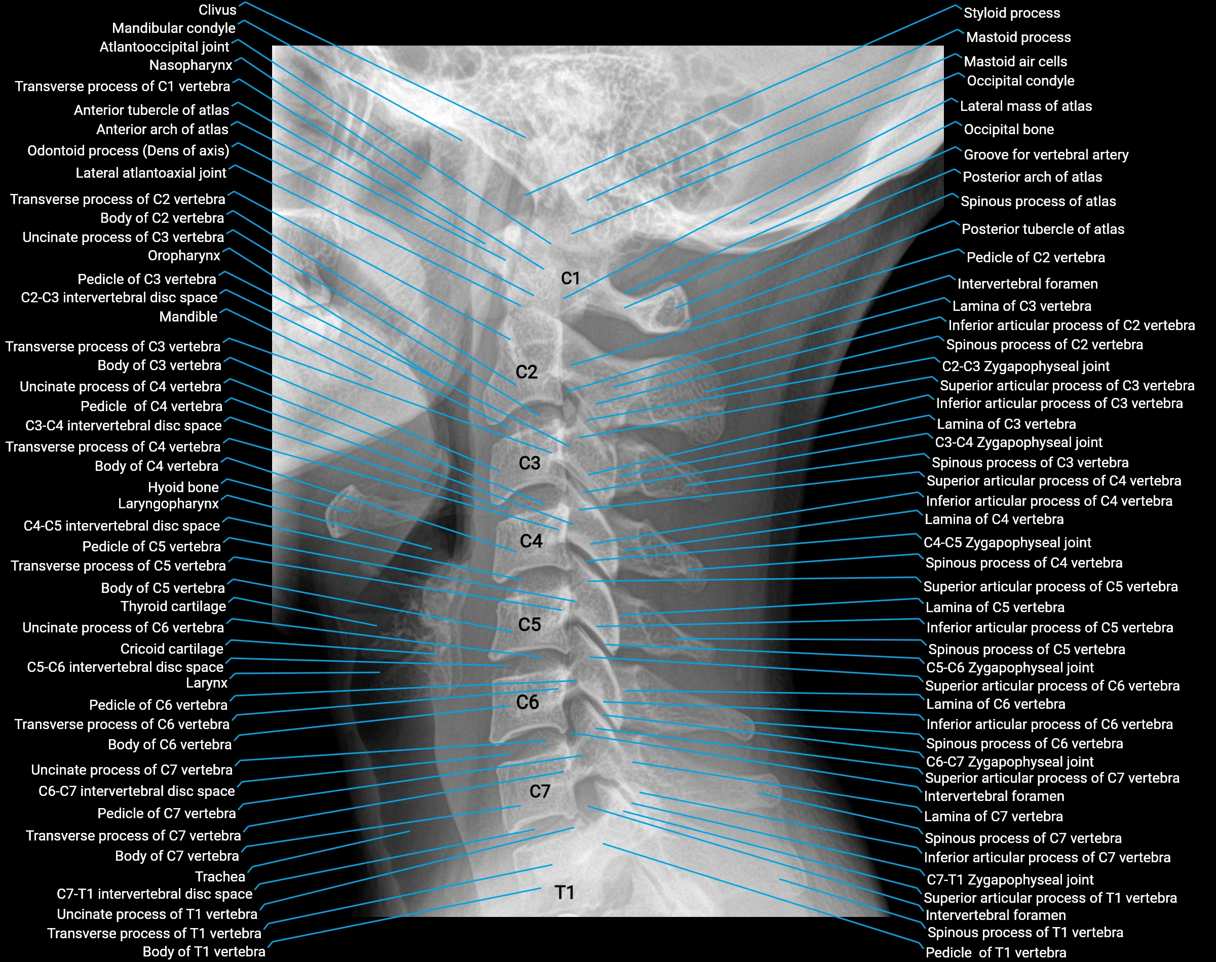 X Ray cervical spine lateral anatomy labelled.webp